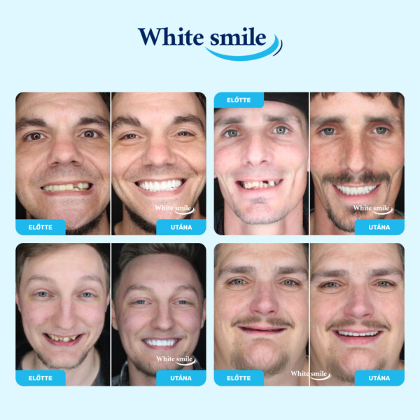 Valósághű műfogak: WhiteSmile - Image 3